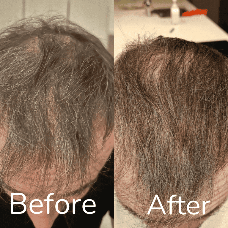 Ian's hair restoration treatment