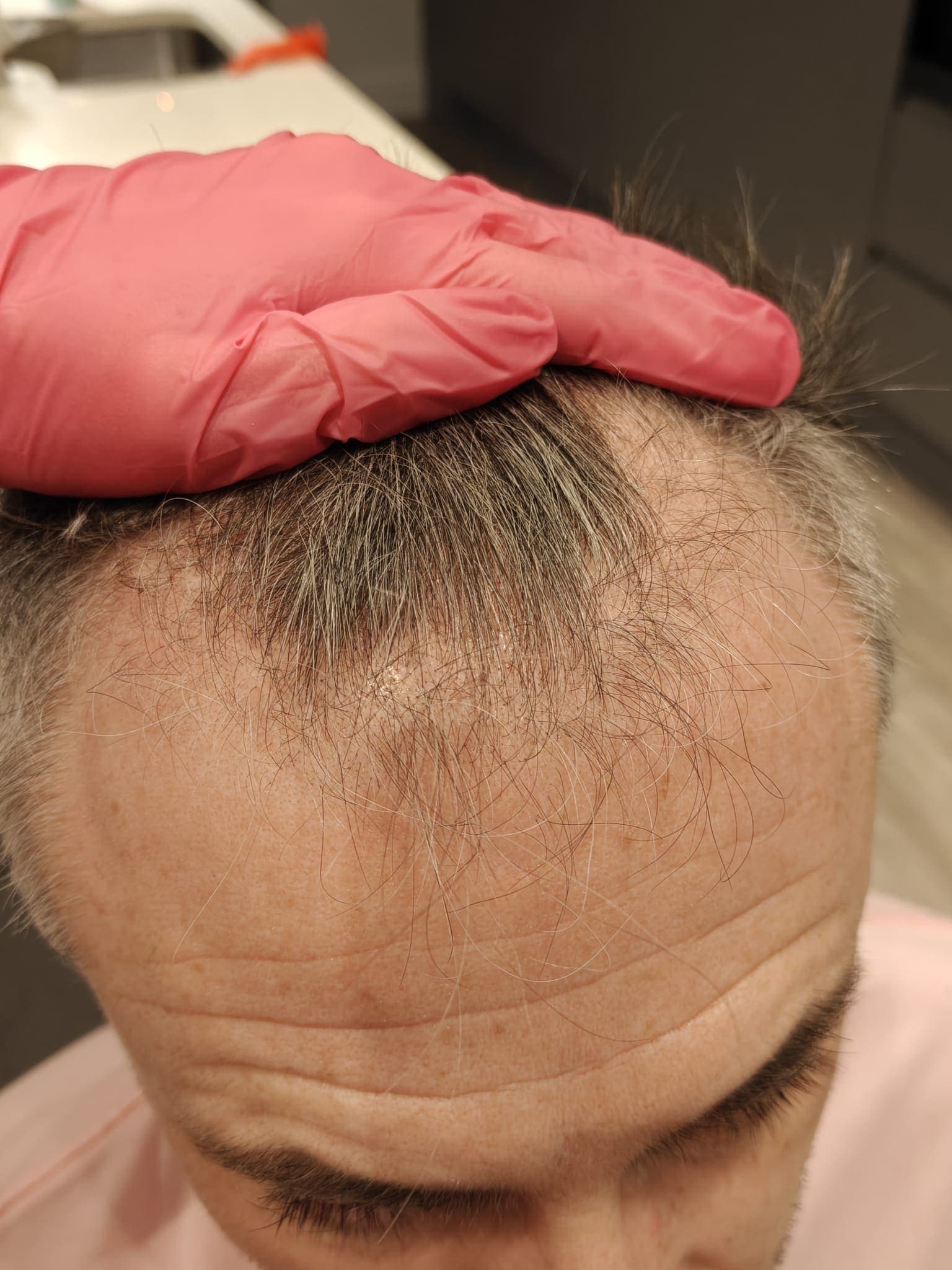 Be-You Hair Clinic Malahide, client result 93