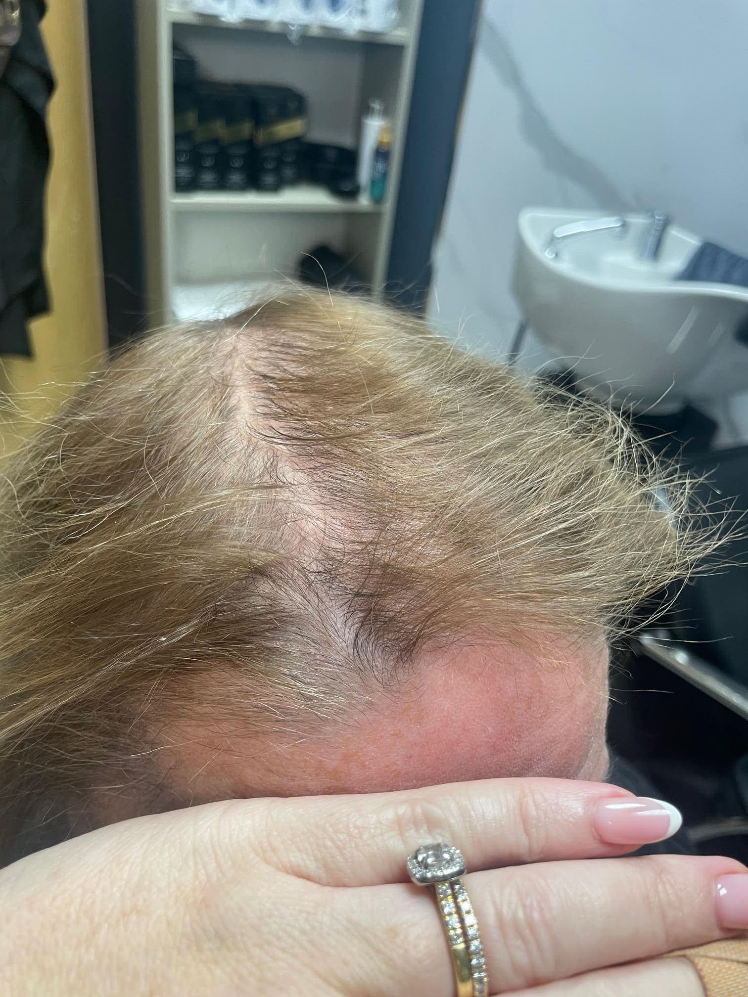 Be-You Hair Clinic Malahide, client result 104