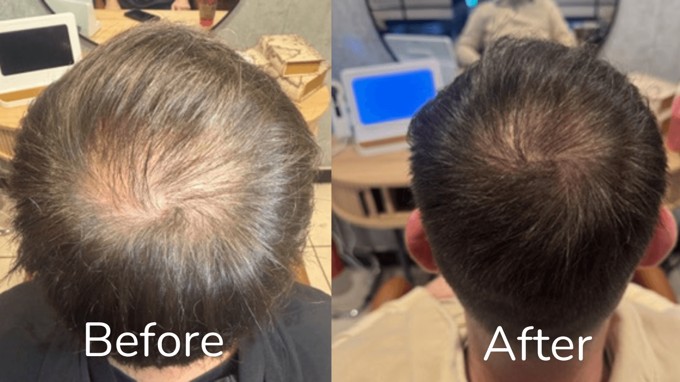 Sean's hair restoration treatment
